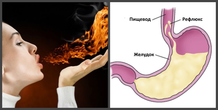 Ларингофарингеальный рефлюкс